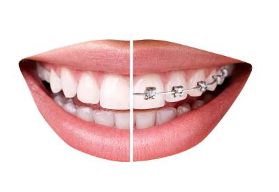 镶牙补牙种牙三者的区别_镶牙和补牙的区别图片