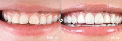 氟对牙齿的作用和功效_氟对牙齿的作用是摄入过多