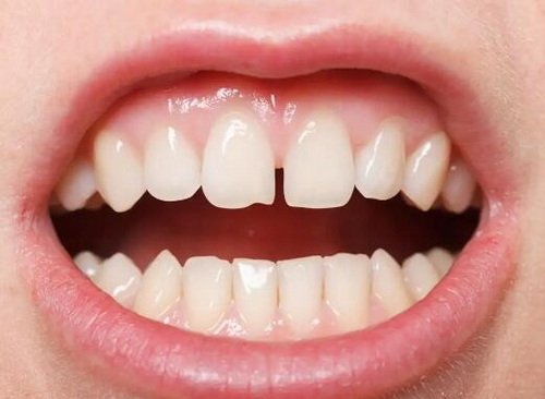 单个牙齿做牙套要多久_有没有单个牙齿的牙套