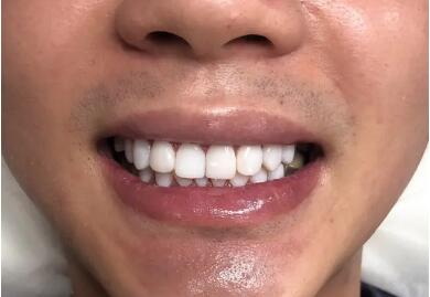 桂林西瓜霜可以治疗牙龈肿痛么_牙龈肿了个大包流脓了该怎么办