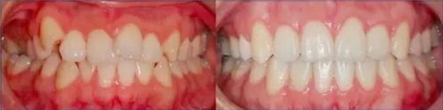 种植牙手术后牙龈白色凸起_种植牙术后感染有什么症状