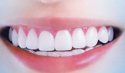 补牙和嵌体的区别是什么