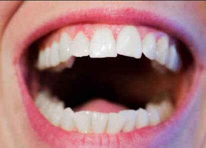 根管治疗烤瓷冠_根管治疗牙后可以矫正牙齿吗