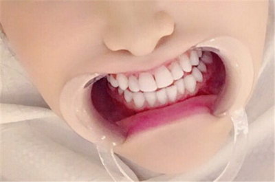 补牙牙套要带多久_补牙的牙套有几种