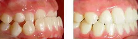左边牙龈疼是什么原因引起的_做的烤瓷牙牙龈萎缩了怎么办