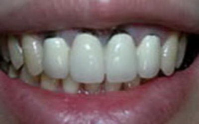拔牙根后多久可以种牙_拔牙根需要切开牙龈吗