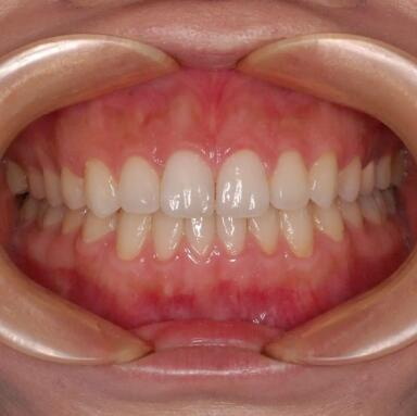 根管治疗后的牙齿发炎鼻子流脓_根管治疗后需要包牙套吗