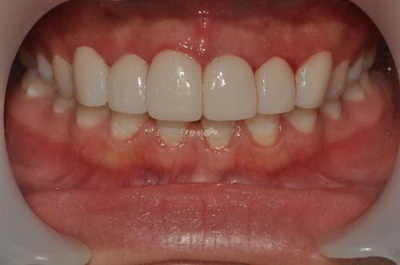 乳牙做根管治疗影响换牙吗(乳牙根管治疗会影响恒牙牙胚)