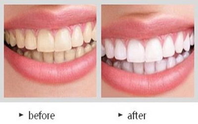 种植牙齿一般要多久(种植牙齿需要多少时间？)