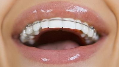 箍牙需要多长时间_箍牙牙齿松动正常吗