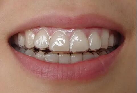 牙齿有点黄怎么洗的白「牙齿有点黑黑怎么去除」