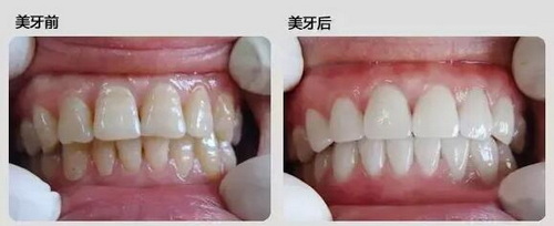 北京补牙医保报销比例_厦门补牙医保定点单位