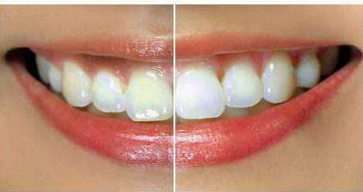 牙齿整齐是什么样子(为什么牙齿整齐很重要？)