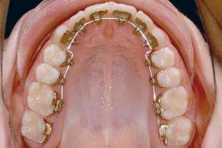 儿童牙齿锯齿状是什么原因_儿童新长的牙齿怎么会是锯齿状的