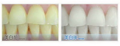 冷光美白牙齿可以维持多长时间_冷光美白牙齿是去除黄牙还是啥