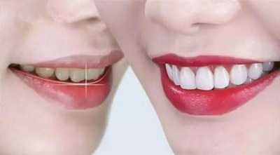 全瓷牙和烤瓷牙哪个质量好一点_全瓷牙齿和烤瓷牙齿有什么区别