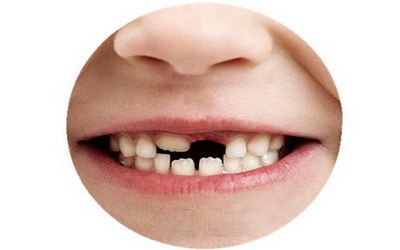 全瓷贴面美牙有哪些副作用