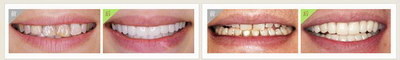 固定牙套和隐形牙套的区别_国产隐形牙套排名