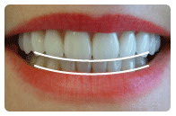 根管治疗后树脂补牙容易裂嘛_做完根管治疗后多久可以补牙
