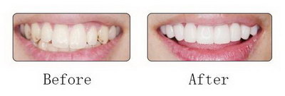 简述根管治疗后牙体修复的重要性_根管治疗第三步后牙疼