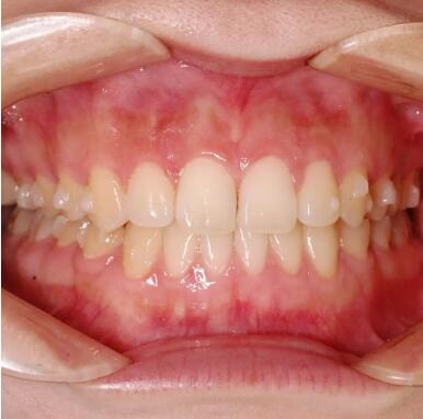 补过的牙齿敲起来有些酸痛_补过的牙齿两年疼痛怎么办