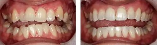 拔牙与抽牙神经哪个伤害大_拔牙之后牙神经还在吗