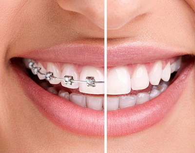 取下来的牙齿有什么用_取牙齿后多久可以安假牙