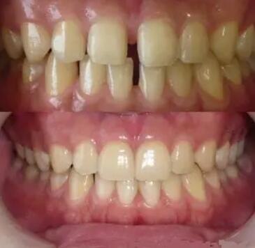 拔牙后牙龈发红伴有疼痛_拔牙后牙龈发红是怎么回事呢