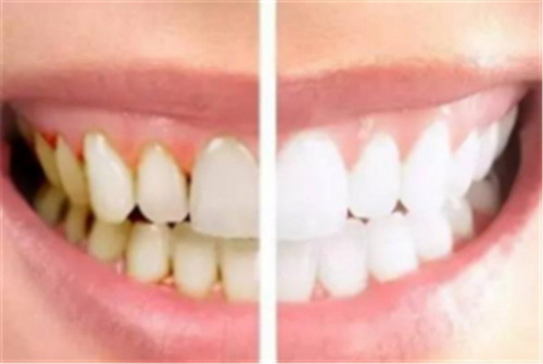 拔牙后牙龈溃疡是怎么回事_拔牙后牙龈凹进去了怎么办