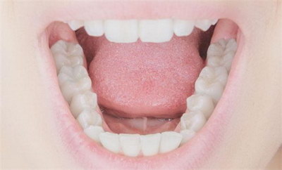 补牙后冷热刺激怎么回事_补牙氢氧化钙垫底的作用