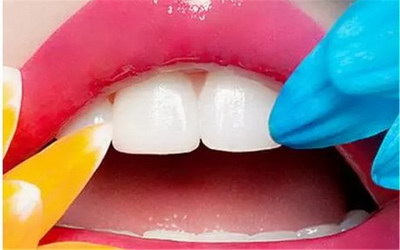 嘴的牙龈总是在出血(牙龈总是出血几个月了怎么办)