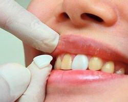 成人牙齿矫正有什么副作用_成人牙齿矫正有没成功的吗