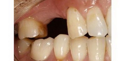 哪种活动假牙_塑料活动假牙