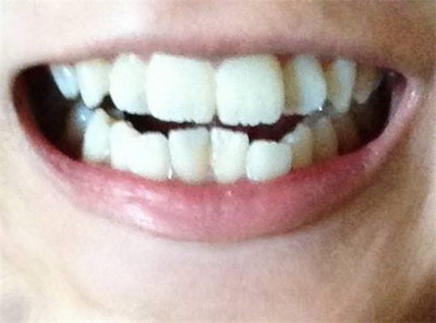 补完牙吃什么消炎药_蛀牙补完牙后牙疼正常吗