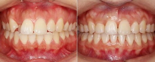 矫正牙齿是全口牙齿都要戴牙套吗