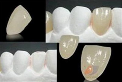 大牙根管治疗需要几次_大牙根管治疗需要几个根管