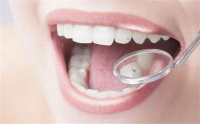 华美牙科可以用医保卡吗_做美牙贴面的好处和坏处