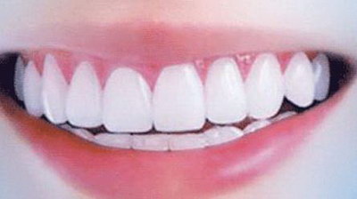牙齿上牙多少颗(上牙是多少颗牙齿)