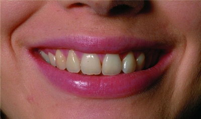 拔牙了几个月了为什么还有一个洞_拔牙之后会出现扁桃体应急症状吗