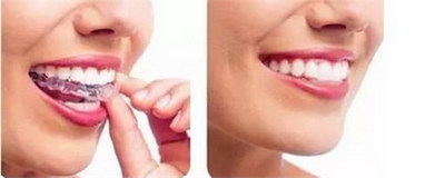 刷牙牙龈频繁出血怎么解决_刷牙牙龈老出血的改善方法