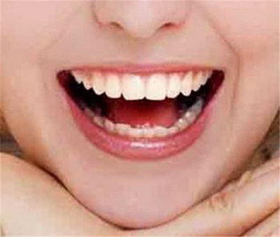 中度龋齿和深度龋齿_最难处理的侧面龋齿