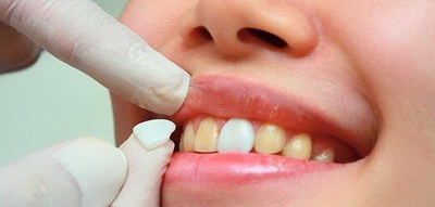 吸附性义齿适应症和禁忌症_吸附性活动义齿有几种类型