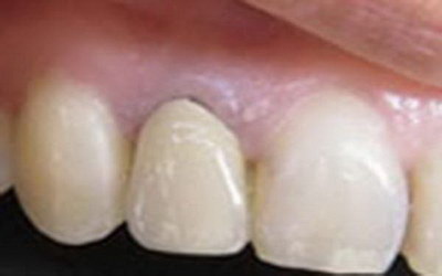 拔牙后牙齿酸痛会持续多久_拔牙后牙齿碎片残留处理