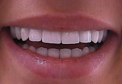 牙齿有洞必须根管治疗吗_根管治疗后第二天牙齿酸