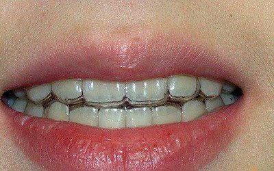 为什么牙齿越长越歪了_为什么牙齿越长越稀疏