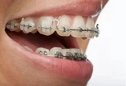 根管治疗期间能洗牙吗_做根管治疗可以洗牙吗