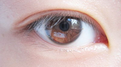 全切双眼皮10毫米恢复图_全切双眼皮10毫米恢复有多宽