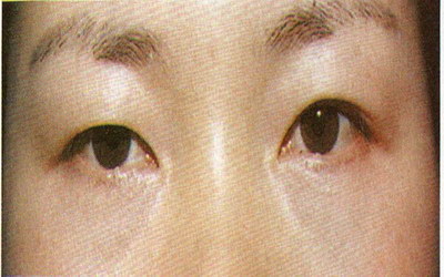 先天性眼皮下垂是什么原因导致的_做完眼袋手术下眼皮下垂眼皮外翻
