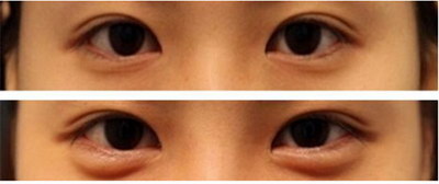 眼霜对黑眼圈有效果吗_淡化黑眼圈最有效的眼霜