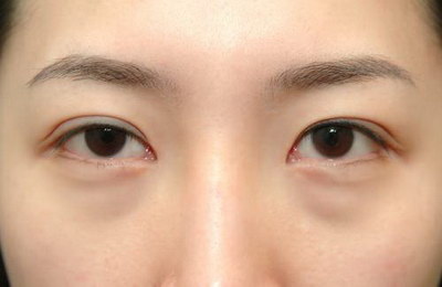 割双眼皮一般能管多少年_割双眼皮一个月还是红肿